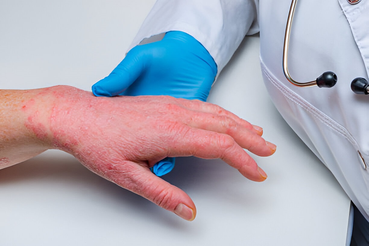 Skin Allergies