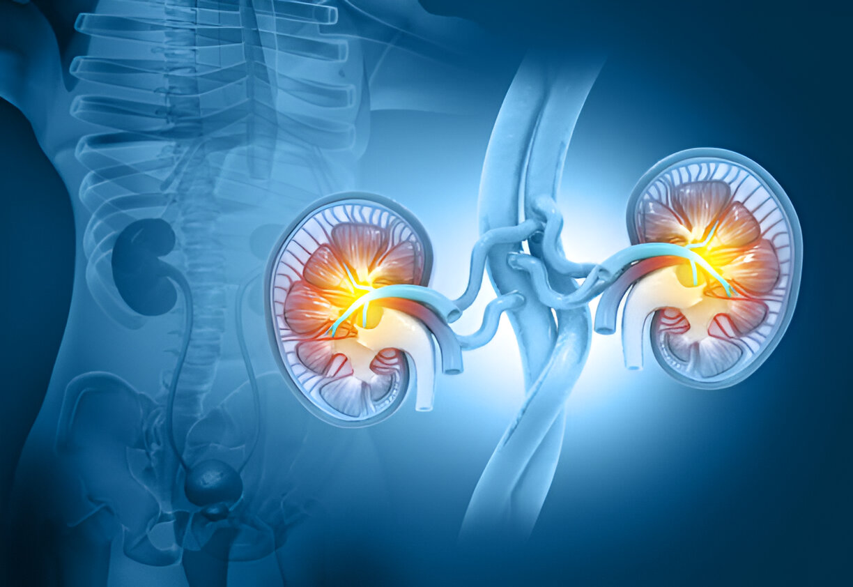 prevent kidney stones
